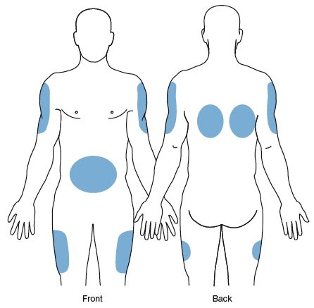 Subcutaneous Injection Sites