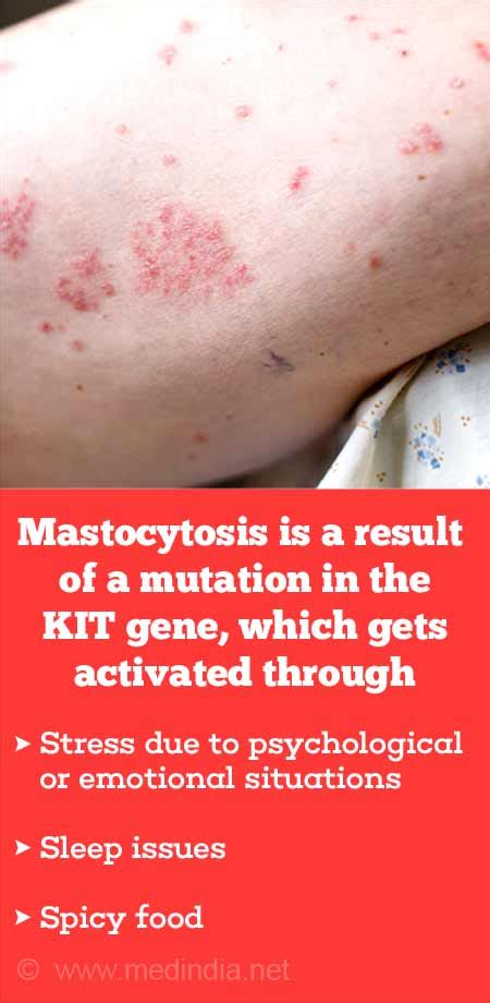 Demystifying Systemic Mastocytosis Causes Symptoms Triggers And