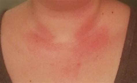 What Is This Rash On My Neck And Chest It Burns And Itches R