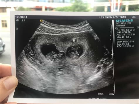 Ultrasound 9 Weeks Pregnant With Twins Belly Pregnantbelly