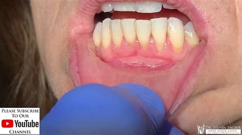 Final Healing Examination After Gum Graft Procedure 👍🏻 Youtube