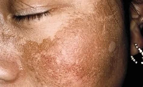 Common Skin Conditions In Black Skin Sugarandfluff