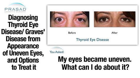 thyroid problems can cause uneven eyes diagnosis and eye hot sex picture