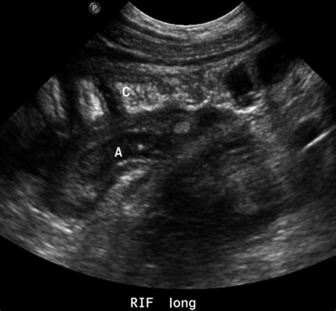 Ultrasound Of Paediatric Appendicitis And Its Secondary Sonographic