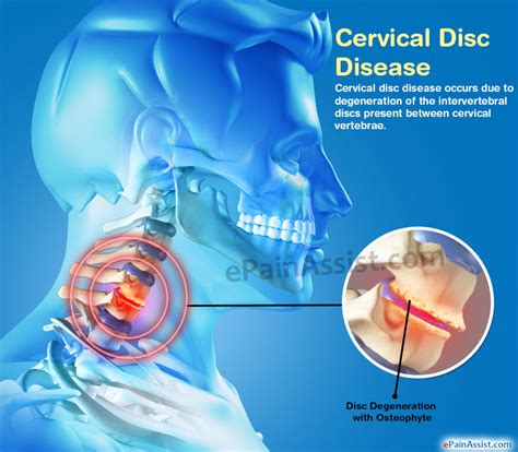 Cervical Disc Diseasesymptomstreatmentlifestyle Management