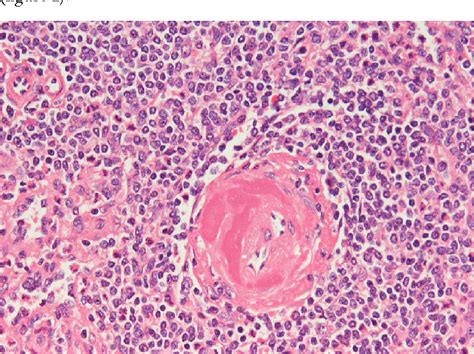 Figure 1 From Splenic Pathology In Traumatic Rupture Of The Spleen A