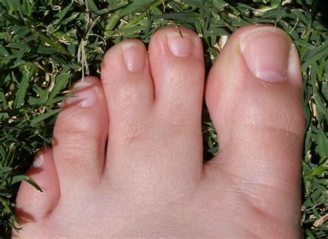 Webbed Toes Wikidoc