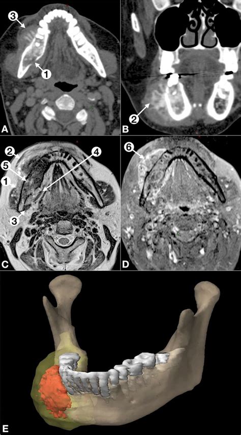 High Grade Osteosarcoma Of The Mandible A Rare Tumor Successfully