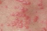 Pictures of How To Manage Herpes Outbreak