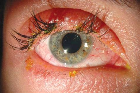 Eyelash Extensions Causing Serious Injuries Such As Chemical Burns And