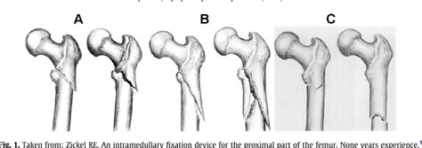 Figure 1 From Subtrochanteric Hip Fractures Treated With Cerclage