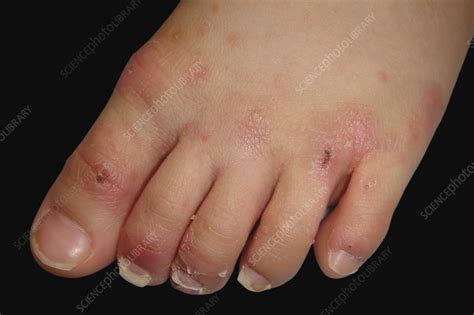 Scabies Lesions On Foot Stock Image C0482893 Science Photo Library