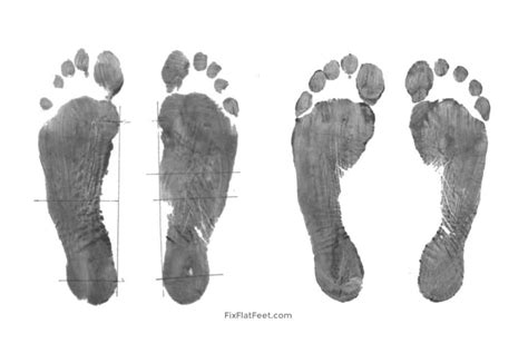 Most people have flat feet are still able to play and work with their daily activities without pain. Can Anyone with Flat Feet Improve Their Arches? - Fix Flat ...
