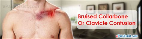 Bruised Collarbone Treatment Causes Symptoms Diagnosis