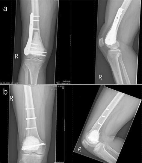 Giant Cell Tumor In The Right Distal Femur Treated With Bone Cement