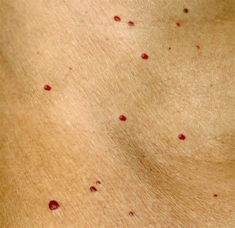 This is a list of characters from the showtime tv series dexter and the jeff lindsay novels, including darkly dreaming dexter (on which the show was based), dearly devoted dexter, dexter in the dark, dexter by design, and dexter is delicious Cutera Excel V+ Laser — Gold Coast Dermatology Clinic