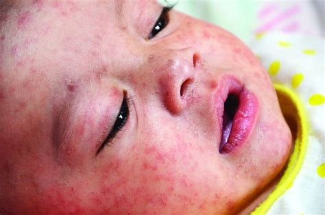 Is It Measles Diagnosis And Management For The Pediatric Provider
