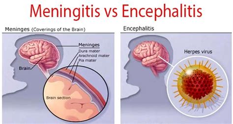 Badan Sehat Dan Ideal Pakai Smart Detox Penyakit Encephalitis Adalah