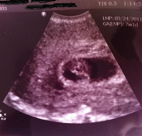 Any pain, dizziness, tissue, or clots could be a sign of ectopic pregnancy or miscarriage. Life with Luca: My pregnancy in ultrasound