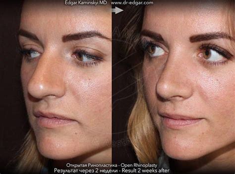 Bulbous Nose Before And After Nose Surgery 1 Rhinoplasty Cost
