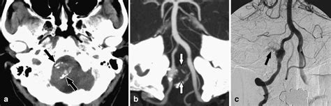 Dissection Of The V4 Segment Of The Vertebral Artery Clinicoradiologic