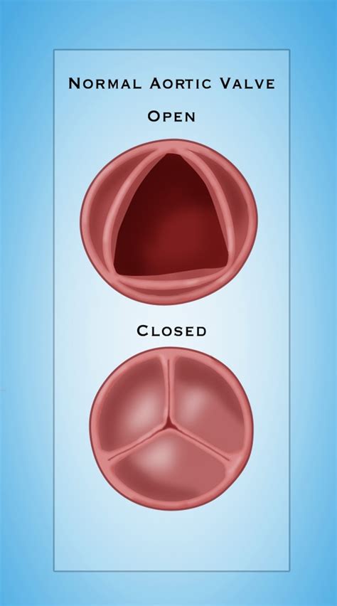 Normal Aortic Valve Poster Print By Monica Schroederscience Source