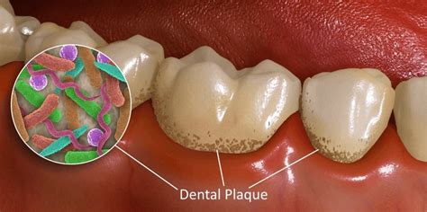 Dental Plaque Bacteria 2 Kuipers Ortho