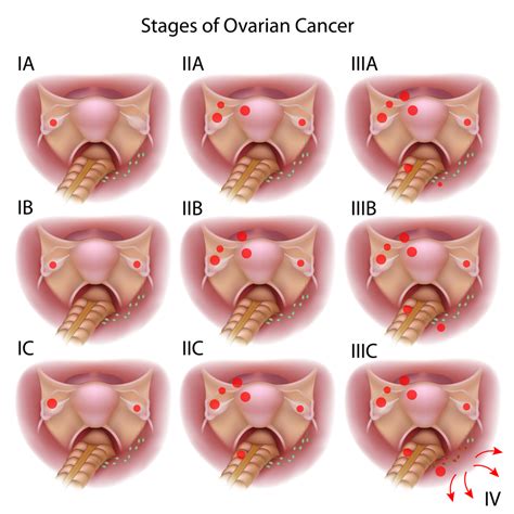 Staging Of Ovarian Cancer Net Health Book