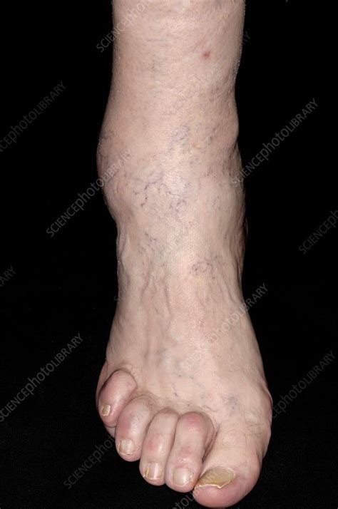 Osteoarthritis Of Ankle Stock Image C0042457 Science Photo Library