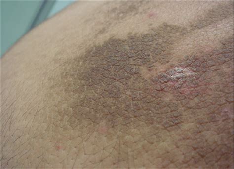 Collection Of Dark Scaly Spots On Skin Actinic Keratosis Potentially