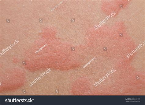 Close Allergy Rash Around Back View Stock Photo 636128177 Shutterstock