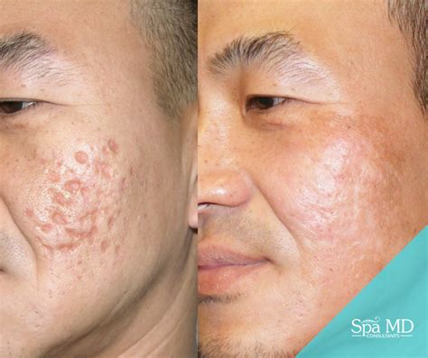 Treatments For Getting Rid Of Deep Acne Scars Spa Md