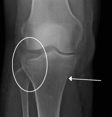 Stress Fracture X Ray Tibia