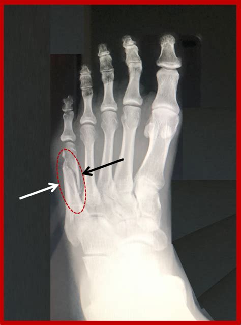 5th Metatarsal Shaft Dancers Fracture Footeducation