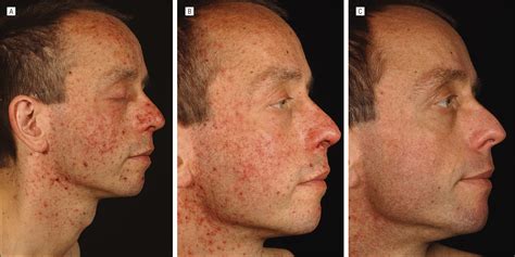 Pimecrolimus A Novel Treatment For Cetuximab Induced Papulopustular Eruption Dermatology