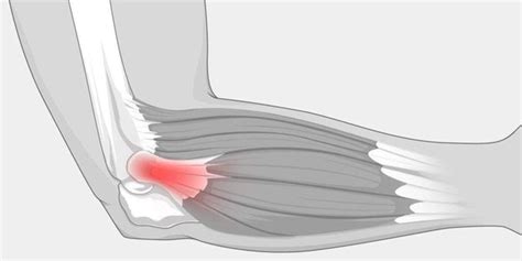 Elbow Tendonitis The Complete Injury Guide Vive Health