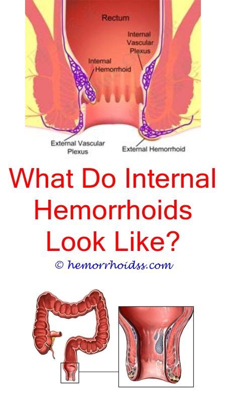 How Do Hemorrhoids Form Cure For Hemorrhoids Hemorrhoids Treatment