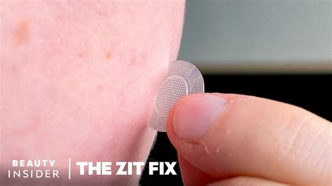Microneedle Patch Stops Early Unpoppable Zits In Their Tracks The Zit