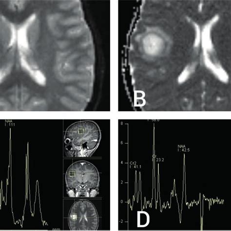 A Diffusion Weighted Imaging Dwi Mri Sequence Showing Bright Signal