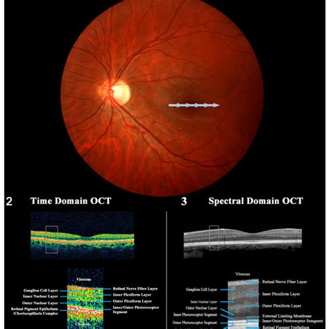 Pdf Optical Coherence Tomography Oct In Optic Neuritis And Multiple