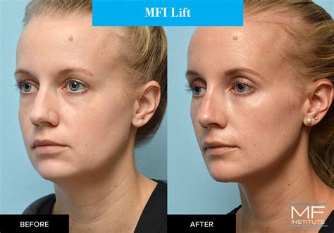 Staff Showcase See Our Own Botox® And Dermal Filler Before And After