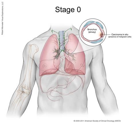 Metastasis occurs when cancer cells separate from the original tumor and move through the body via the blood or lymph system. Lung Cancer - Non-Small Cell: Stages | Cancer.Net