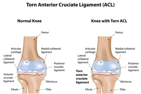 Acl accurately identifies and controls packets on the network to manage network access behaviors, prevent network attacks, and improve bandwidth use efficiency. ACL Tear | Knee Specialist | Austin, Round Rock, Cedar Park TX