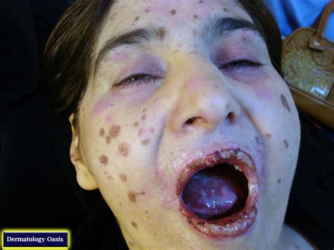 Stevens Johnson syndrome | Dermatology Oasis