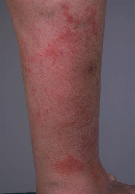 Eczema Lower Legs Dorothee Padraig South West Skin Health Care