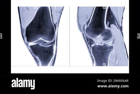 Compare Of Mri Knee Or Magnetic Resonance Imaging Of Knee Joint Coronal