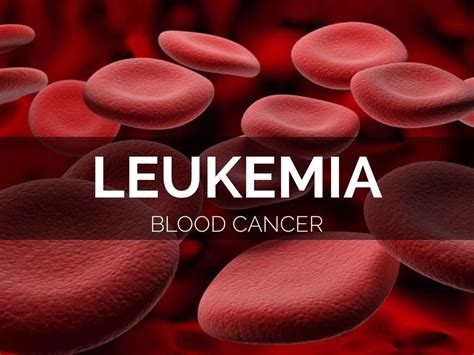 Leukemia 10 Leukemia Symptoms