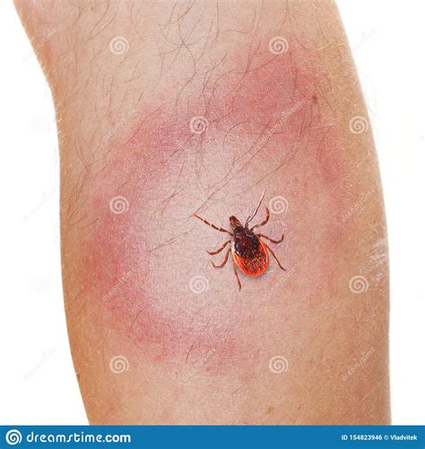 Tick On Human Leg Dangerous Parasite On Human Skin Stock Photo