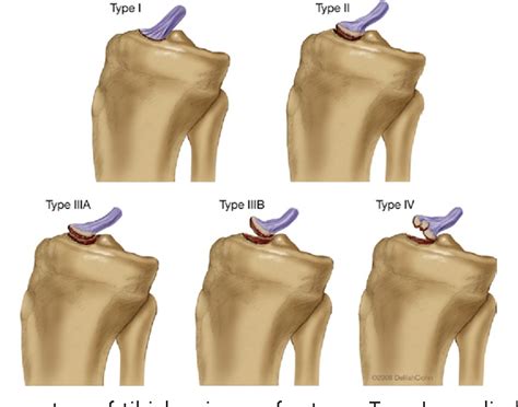 Figure 1 From Tibial Eminence Fractures Semantic Scholar