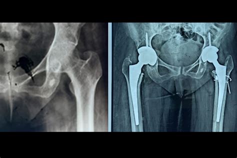 Total Hip Replacement Dr Debasish Naskar Orthopaedic Surgeon